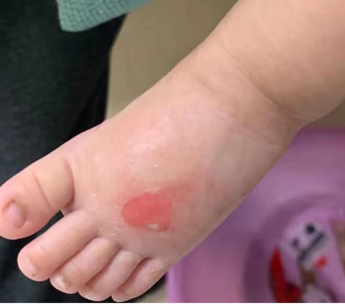 留置针怎么贴膜小儿医用黏胶性损伤和贴膜过敏的案例分析_https://www.jmylbn.com_新闻资讯_第7张