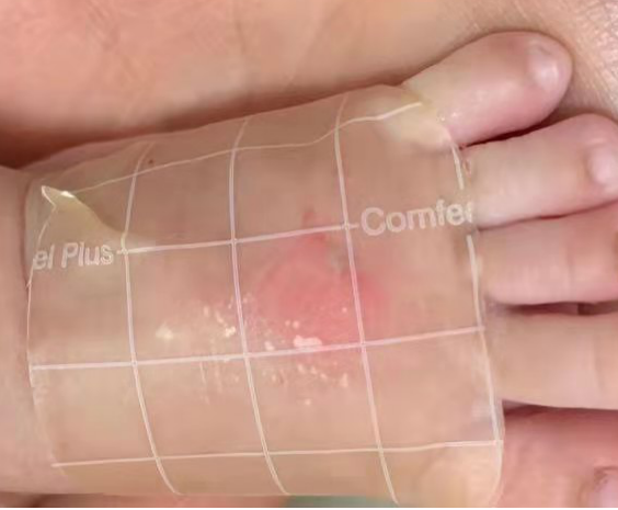 留置针怎么贴膜小儿医用黏胶性损伤和贴膜过敏的案例分析_https://www.jmylbn.com_新闻资讯_第8张