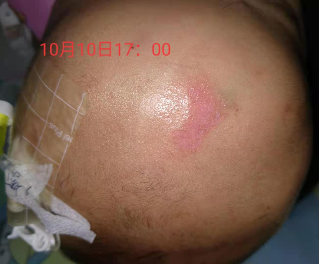 留置针怎么贴膜小儿医用黏胶性损伤和贴膜过敏的案例分析_https://www.jmylbn.com_新闻资讯_第6张