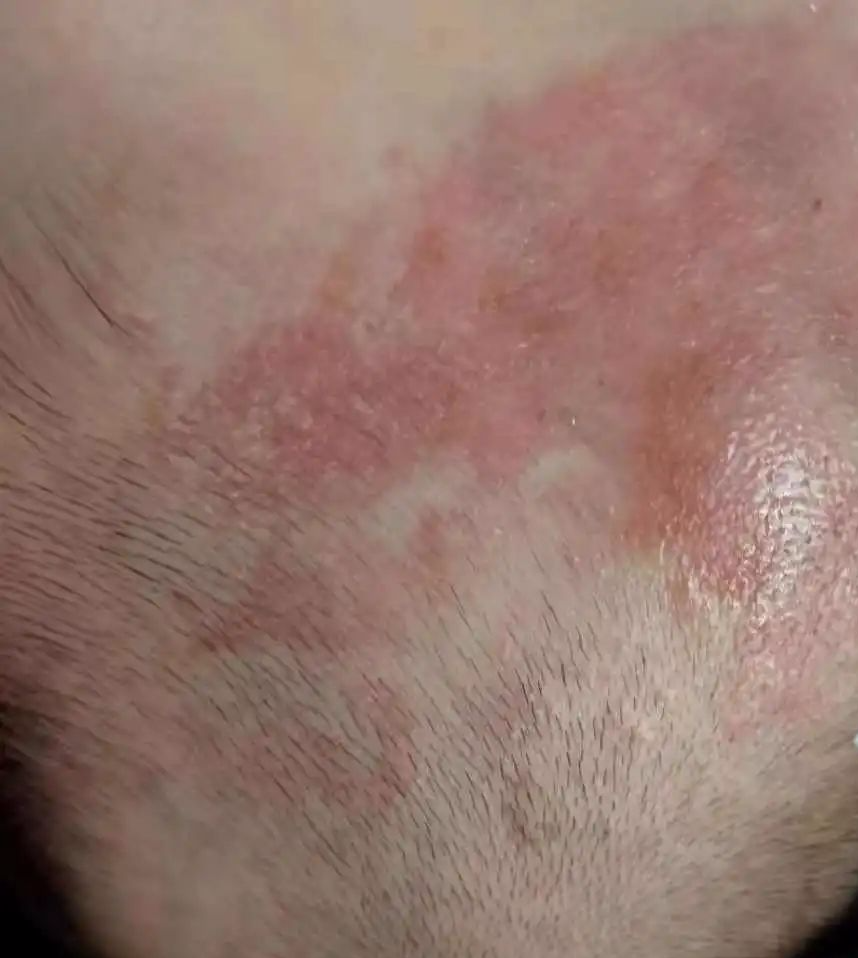 留置针怎么贴膜小儿医用黏胶性损伤和贴膜过敏的案例分析_https://www.jmylbn.com_新闻资讯_第10张