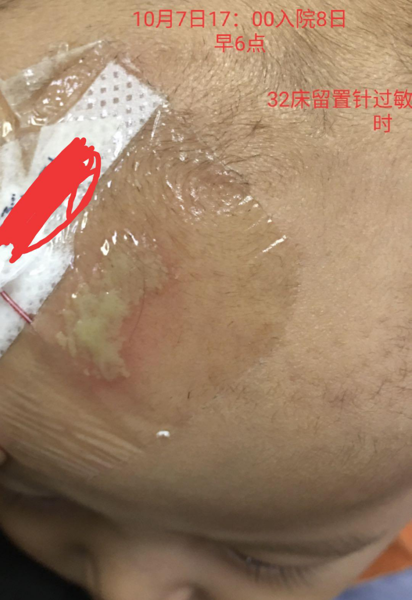 留置针怎么贴膜小儿医用黏胶性损伤和贴膜过敏的案例分析_https://www.jmylbn.com_新闻资讯_第2张