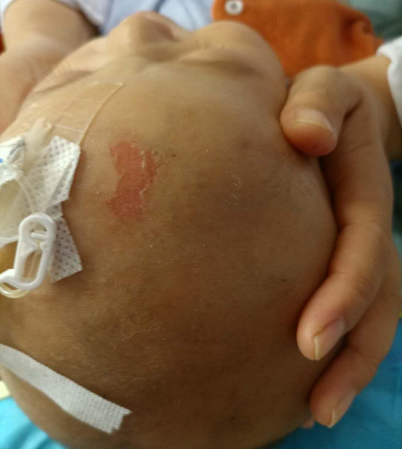 留置针怎么贴膜小儿医用黏胶性损伤和贴膜过敏的案例分析_https://www.jmylbn.com_新闻资讯_第3张