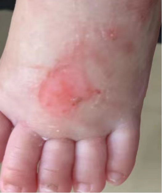 留置针怎么贴膜小儿医用黏胶性损伤和贴膜过敏的案例分析_https://www.jmylbn.com_新闻资讯_第9张