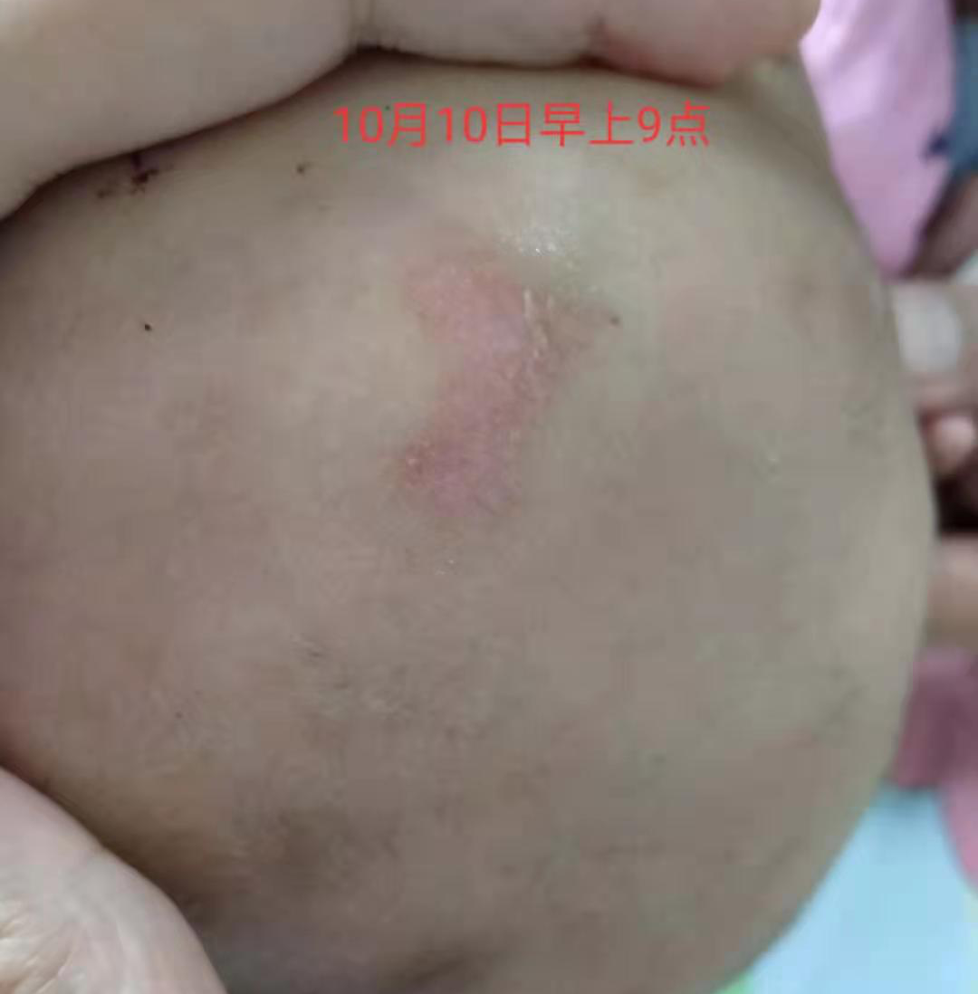 留置针怎么贴膜小儿医用黏胶性损伤和贴膜过敏的案例分析_https://www.jmylbn.com_新闻资讯_第5张