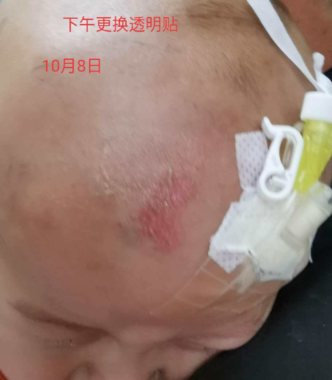 留置针怎么贴膜小儿医用黏胶性损伤和贴膜过敏的案例分析_https://www.jmylbn.com_新闻资讯_第4张