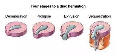 椎間盤突出的康復訓練 健康 第3張