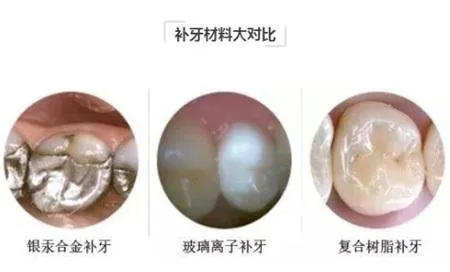牙科玻璃离子怎么去除受牙科医生喜爱的玻璃离子水门汀_https://www.jmylbn.com_新闻资讯_第4张