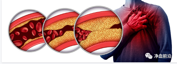 光子治疗仪有什么效果心脏的保护神——洫通光子冠心病治疗仪_https://www.jmylbn.com_新闻资讯_第31张