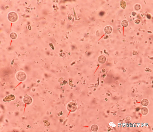 检,仅凭湿片高倍镜观察,没有经验的老师可能会误认为白细胞而发出报告