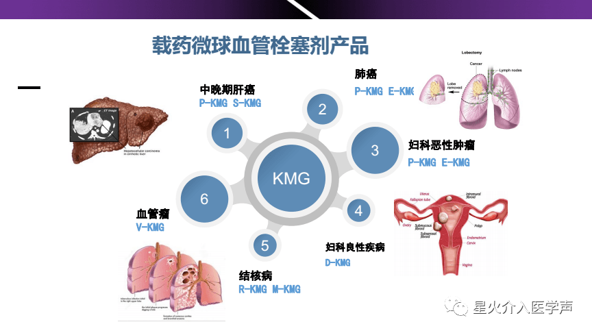 明胶在血管怎么降解介入治疗常用栓塞剂_https://www.jmylbn.com_新闻资讯_第2张