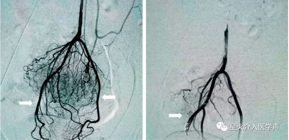 明胶在血管怎么降解不同栓塞颗粒在直肠上动脉栓塞慢性痔出血中的比较：明胶海绵与微球_https://www.jmylbn.com_新闻资讯_第4张