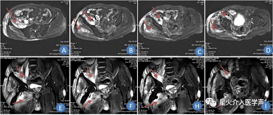 介入引流管怎么关介入下经股管负压引流化脓性阑尾炎术后盆腔脓肿导致股脓肿1例_https://www.jmylbn.com_新闻资讯_第4张