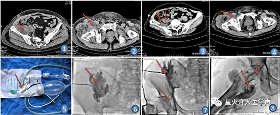 介入引流管怎么关介入下经股管负压引流化脓性阑尾炎术后盆腔脓肿导致股脓肿1例_https://www.jmylbn.com_新闻资讯_第3张