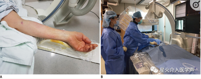 桡动脉鞘怎么读经桡动脉通路外周介入治疗最新综述_https://www.jmylbn.com_新闻资讯_第4张