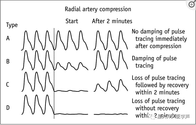 桡动脉鞘怎么读经桡动脉通路外周介入治疗最新综述_https://www.jmylbn.com_新闻资讯_第3张