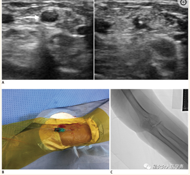 桡动脉鞘怎么读经桡动脉通路外周介入治疗最新综述_https://www.jmylbn.com_新闻资讯_第5张