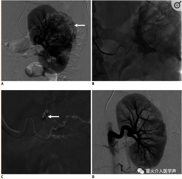 桡动脉鞘怎么读经桡动脉通路外周介入治疗最新综述_https://www.jmylbn.com_新闻资讯_第10张