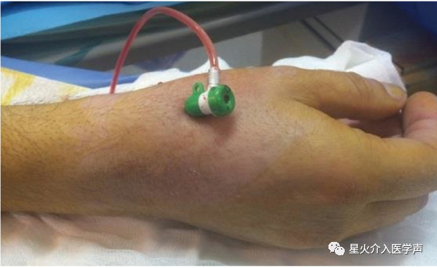 桡动脉鞘怎么读经桡动脉通路外周介入治疗最新综述_https://www.jmylbn.com_新闻资讯_第6张