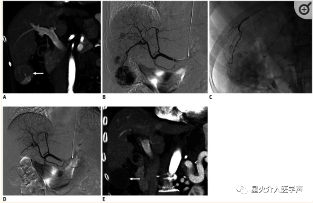 桡动脉鞘怎么读经桡动脉通路外周介入治疗最新综述_https://www.jmylbn.com_新闻资讯_第9张