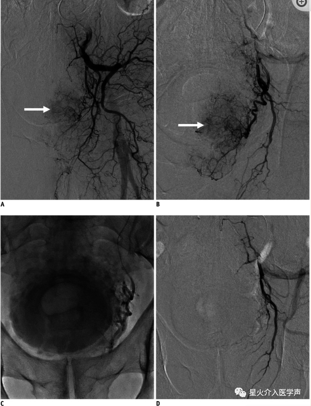 桡动脉鞘怎么读经桡动脉通路外周介入治疗最新综述_https://www.jmylbn.com_新闻资讯_第11张