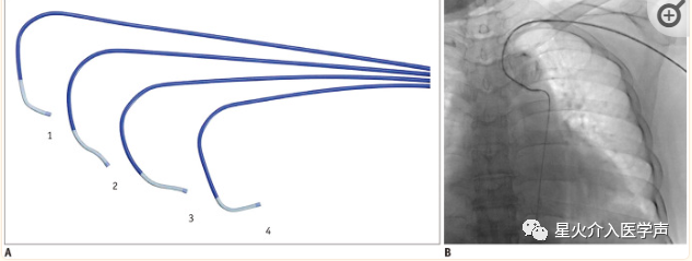 桡动脉鞘怎么读经桡动脉通路外周介入治疗最新综述_https://www.jmylbn.com_新闻资讯_第7张