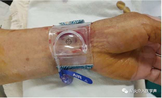 桡动脉鞘怎么读经桡动脉通路外周介入治疗最新综述_https://www.jmylbn.com_新闻资讯_第8张