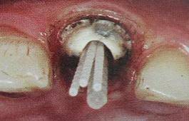 手把手教你纤维桩修复的精细化操作