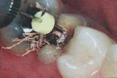 手把手教你纤维桩修复的精细化操作