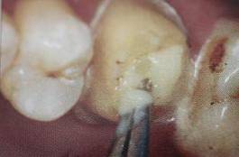 手把手教你纤维桩修复的精细化操作