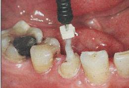 手把手教你纤维桩修复的精细化操作