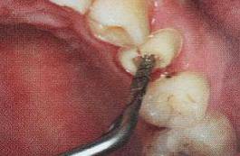 手把手教你纤维桩修复的精细化操作