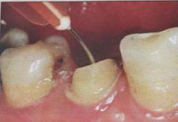 手把手教你纤维桩修复的精细化操作