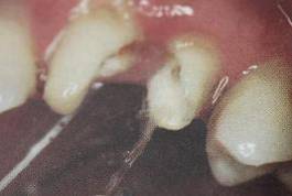 手把手教你纤维桩修复的精细化操作