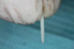 手把手教你纤维桩修复的精细化操作