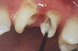 手把手教你纤维桩修复的精细化操作