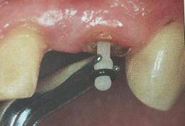 手把手教你纤维桩修复的精细化操作