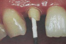 手把手教你纤维桩修复的精细化操作
