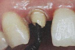 手把手教你纤维桩修复的精细化操作