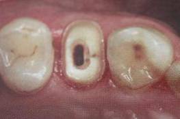 手把手教你纤维桩修复的精细化操作