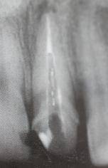 手把手教你纤维桩修复的精细化操作