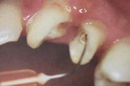 手把手教你纤维桩修复的精细化操作