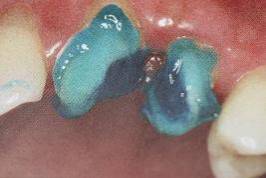 手把手教你纤维桩修复的精细化操作