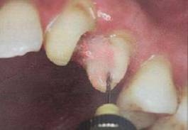 手把手教你纤维桩修复的精细化操作