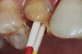 手把手教你纤维桩修复的精细化操作