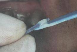 手把手教你纤维桩修复的精细化操作