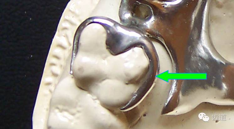 卡环的结构和各部分的作用