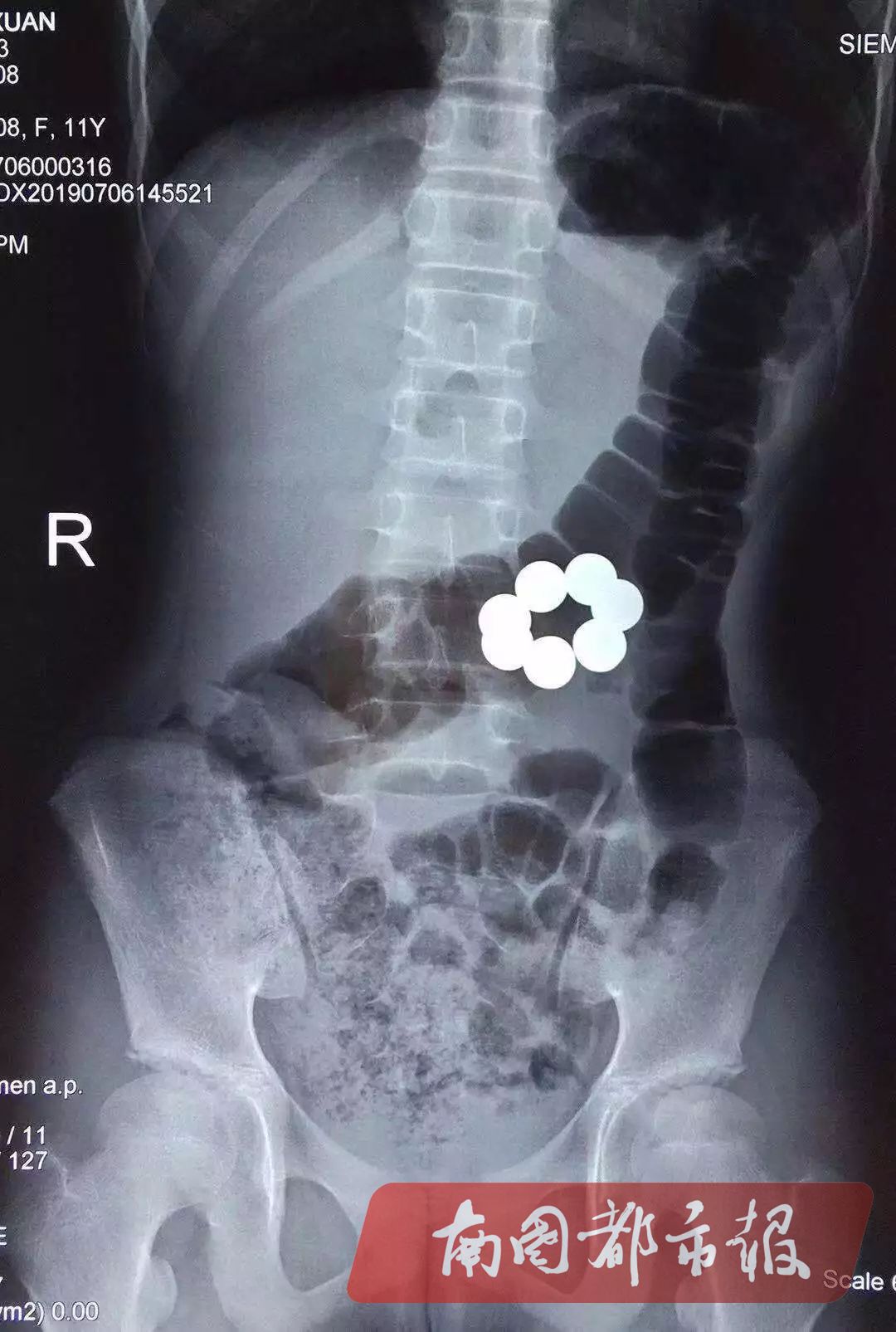 太任性！萬寧一11歲女孩生吞7顆磁力珠，原因令人氣憤... 健康 第4張