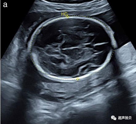 胎儿mt是什么检查什么疼吗【文献学习】【规范、指南】ISUOG实践指南：中孕期胎儿常规超声检查（2022更新）_https://www.jmylbn.com_新闻资讯_第2张
