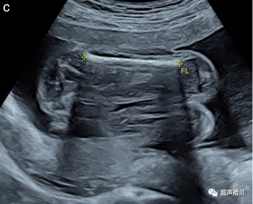 胎儿mt是什么检查什么疼吗【文献学习】【规范、指南】ISUOG实践指南：中孕期胎儿常规超声检查（2022更新）_https://www.jmylbn.com_新闻资讯_第4张