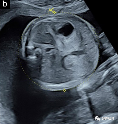 胎儿mt是什么检查什么疼吗【文献学习】【规范、指南】ISUOG实践指南：中孕期胎儿常规超声检查（2022更新）_https://www.jmylbn.com_新闻资讯_第3张